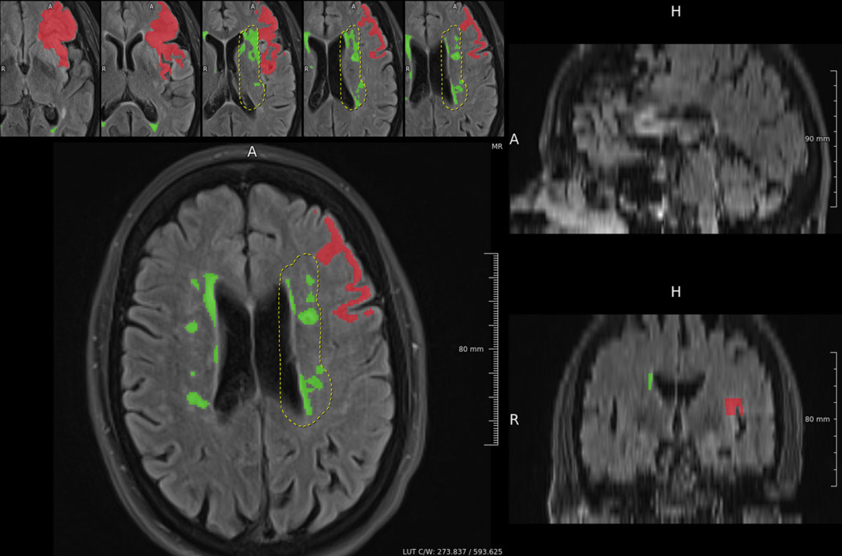 Deep Learning and lesion segmentation CSI